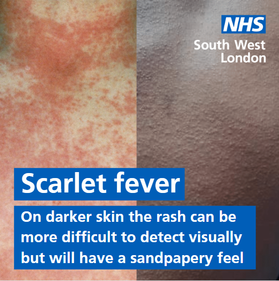 Scarlet Fever Cure  Side Effects of Scarlet Fever