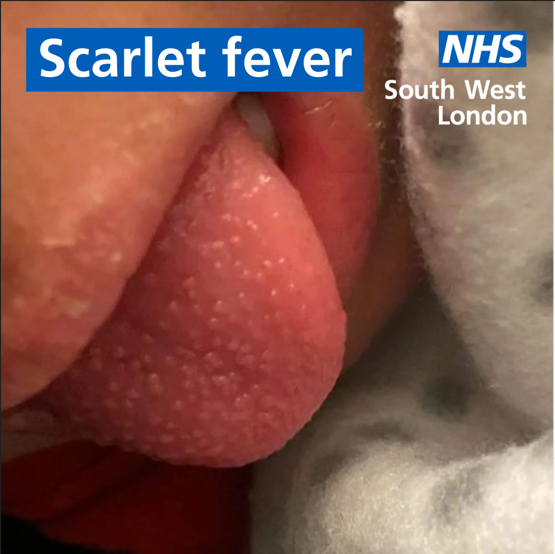 Scarlet fever - what you need to know - Wandsworth Borough Council